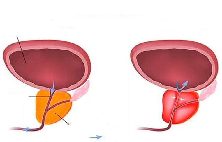 normal and swollen prostate