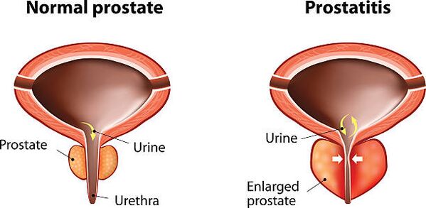 normal and swollen prostate