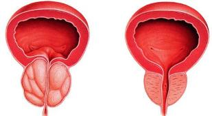 the difference sick and healthy prostate