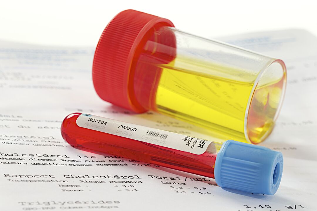 A blood and urine test will help determine the presence of prostatitis. 